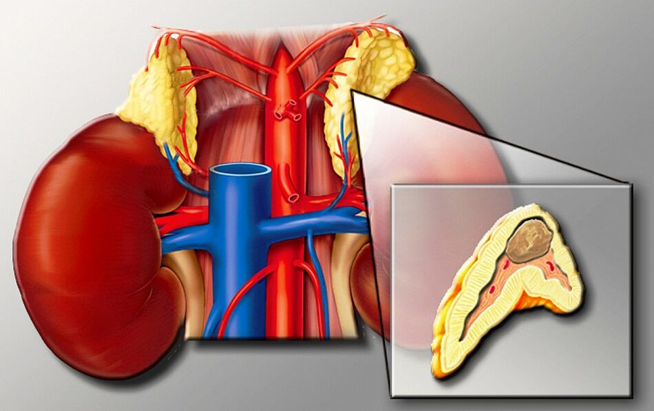 Hypemension pheochromocytoma