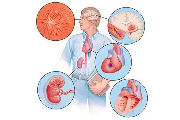 Damage to various organs caused by long-term arterial hypertension